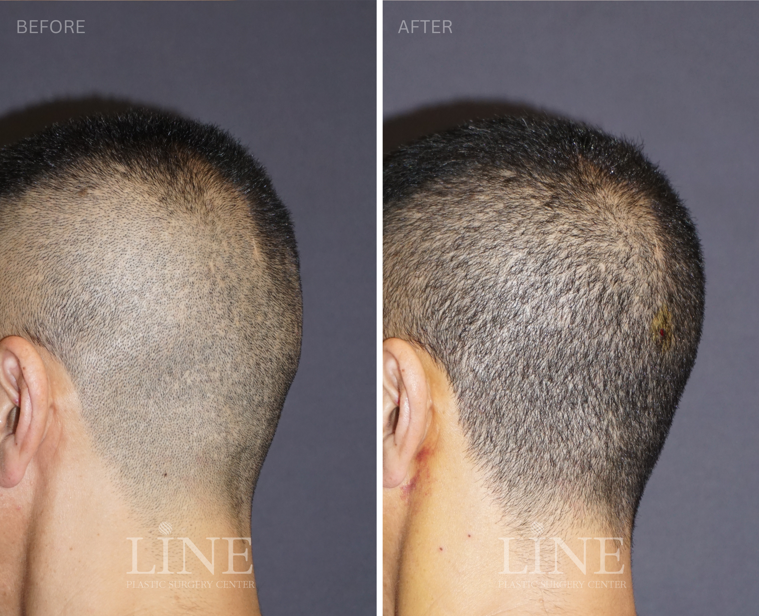 OCCIPITAL SKULL RESHAPING (3)