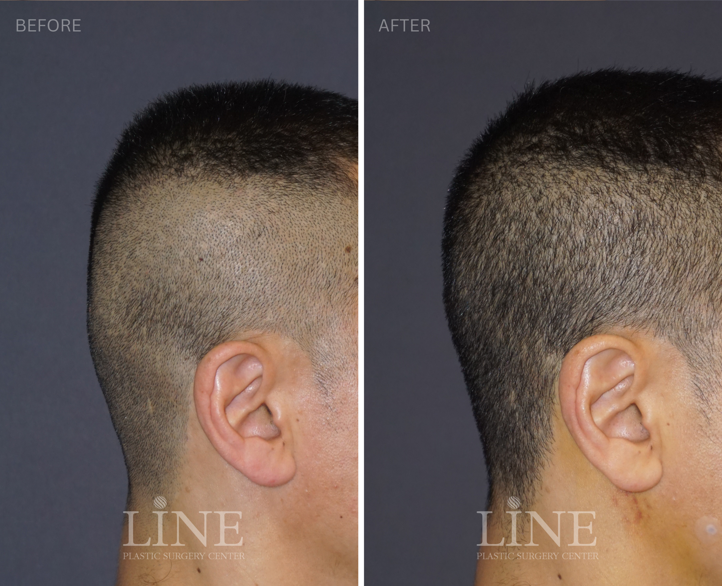 OCCIPITAL SKULL RESHAPING (4)