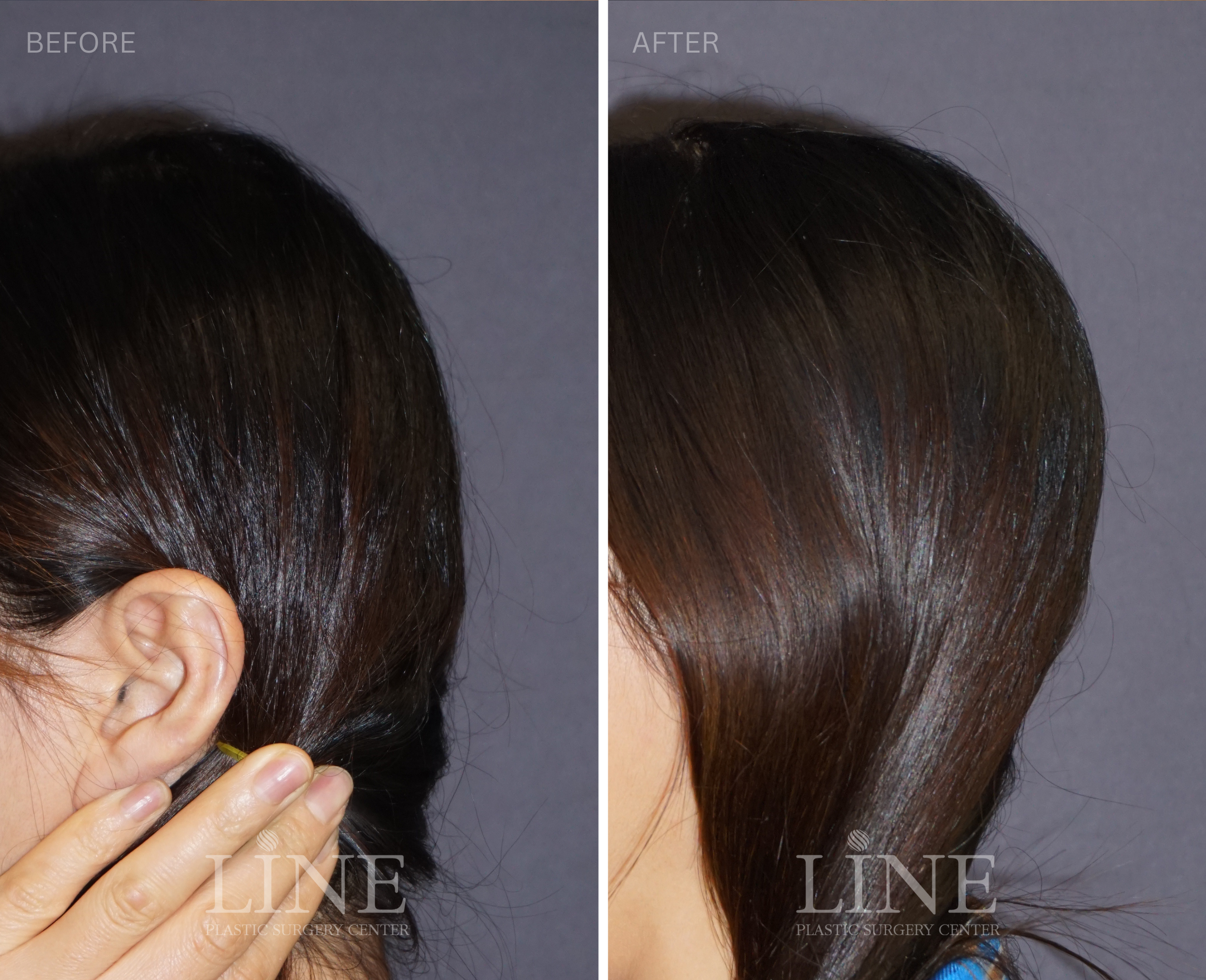 OCCIPITAL SKULL RESHAPING (5)