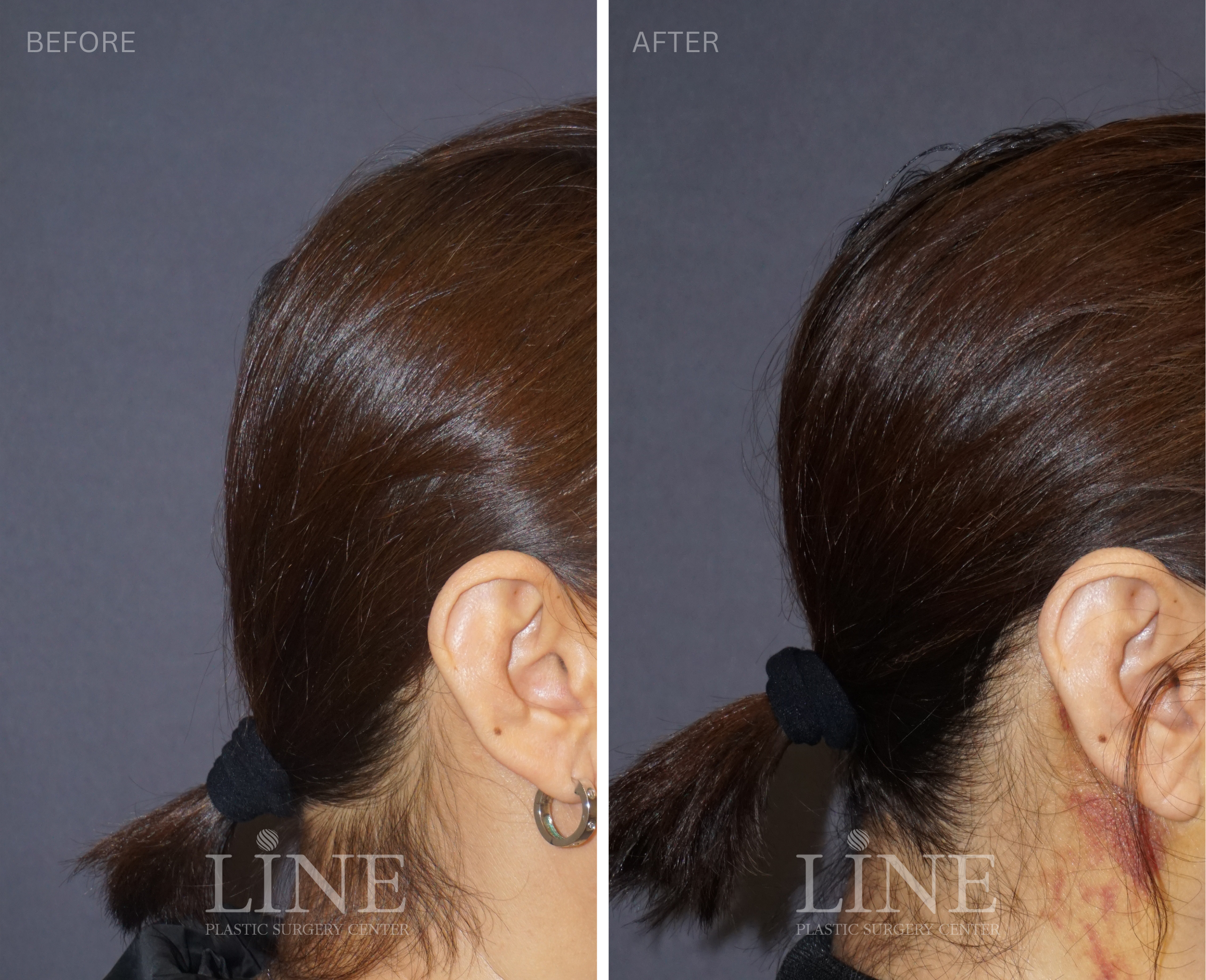 OCCIPITAL SKULL RESHAPING (6)