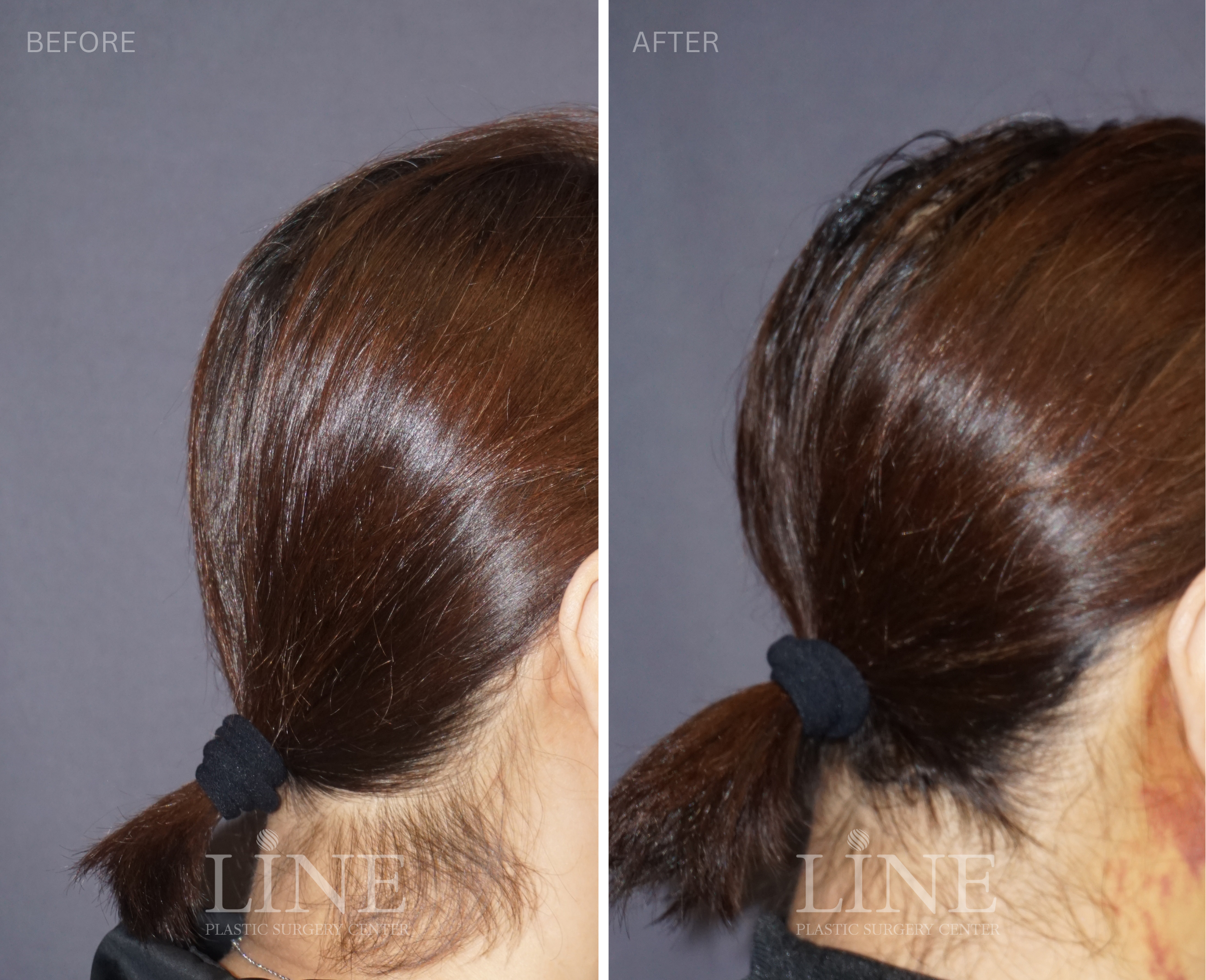 OCCIPITAL SKULL RESHAPING (7)