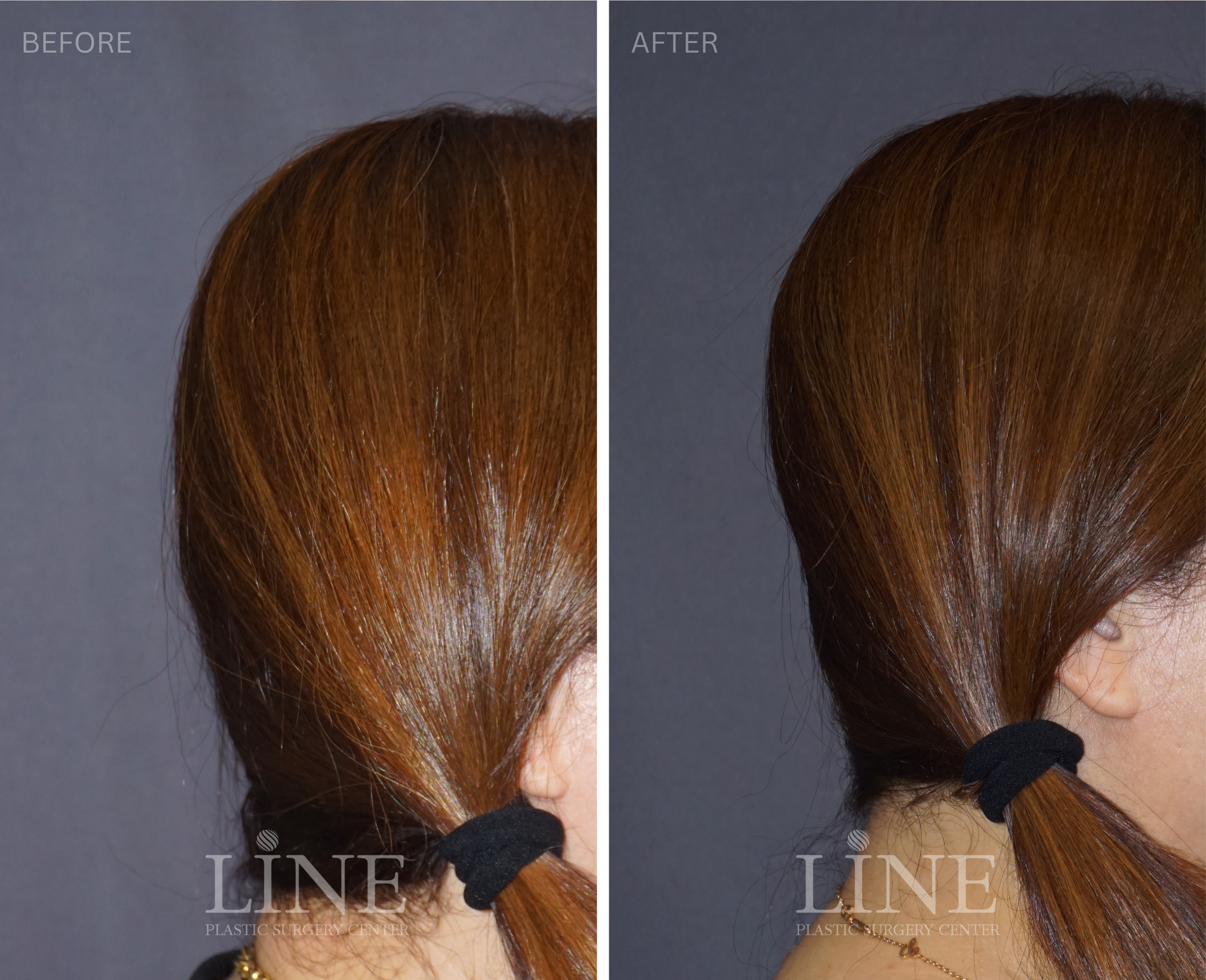OCCIPITAL SKULL RESHAPING (8)