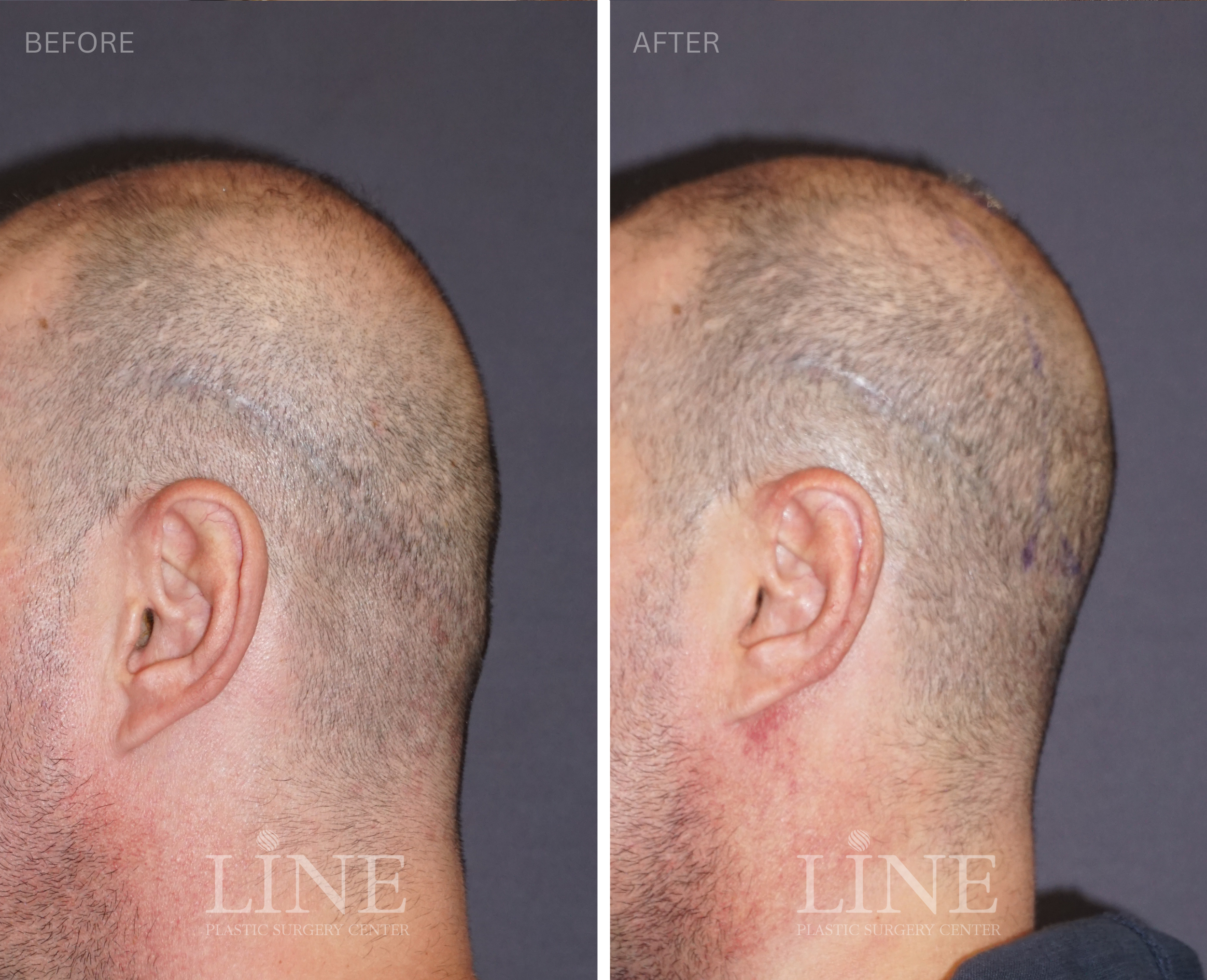 OCCIPITAL SKULL RESHAPING (9)