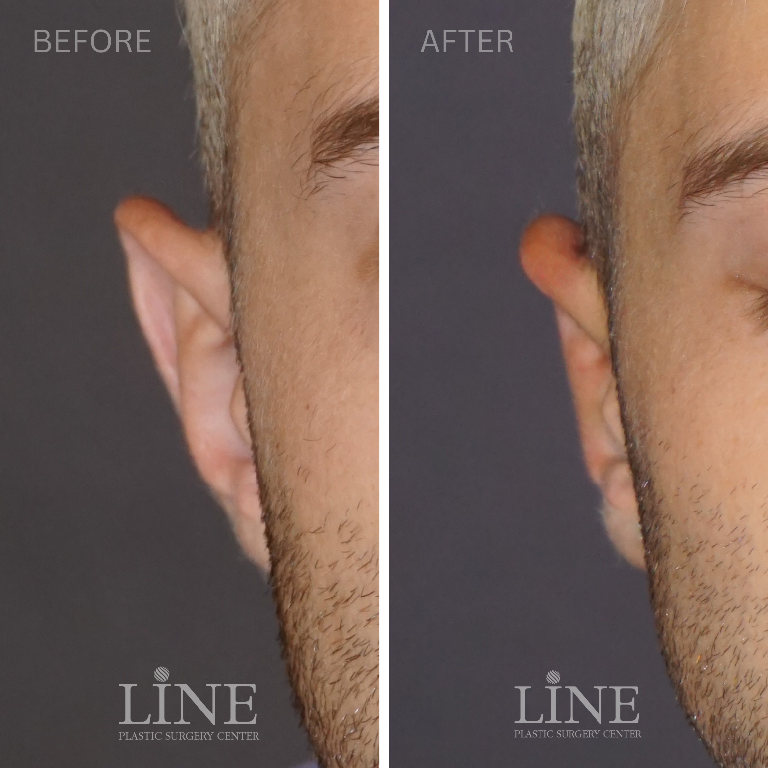 OTOPLASTY (1)