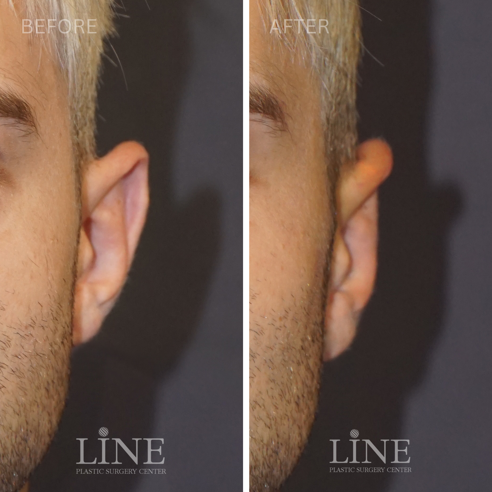 OTOPLASTY (2)
