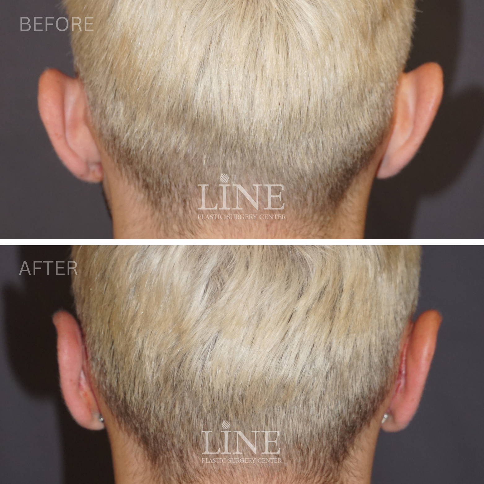 OTOPLASTY (3)