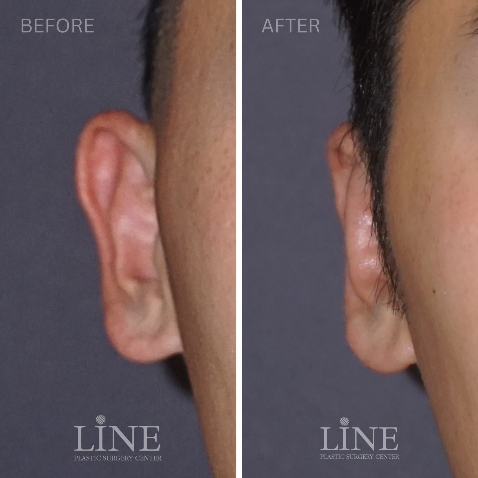 OTOPLASTY (4)
