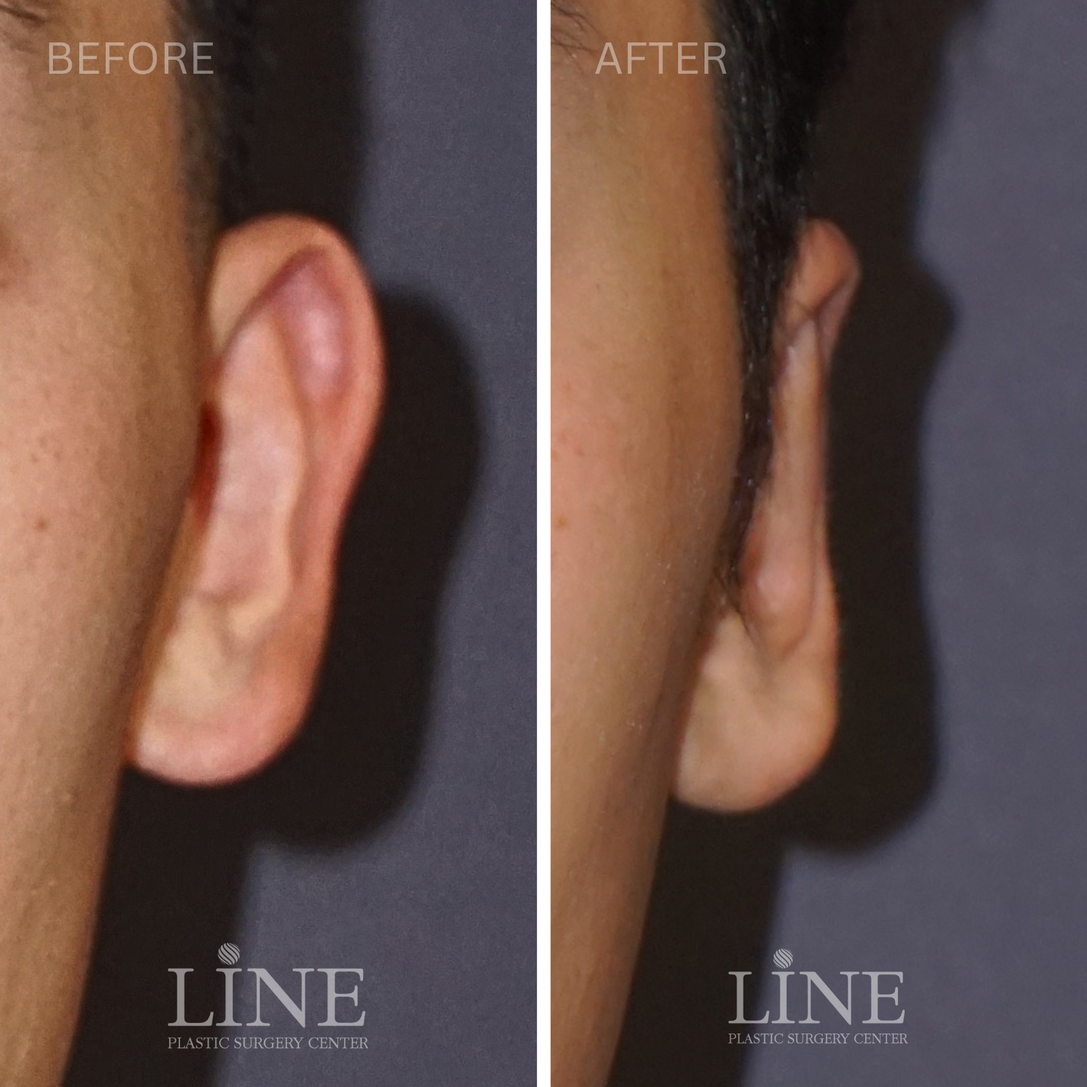 OTOPLASTY (5)