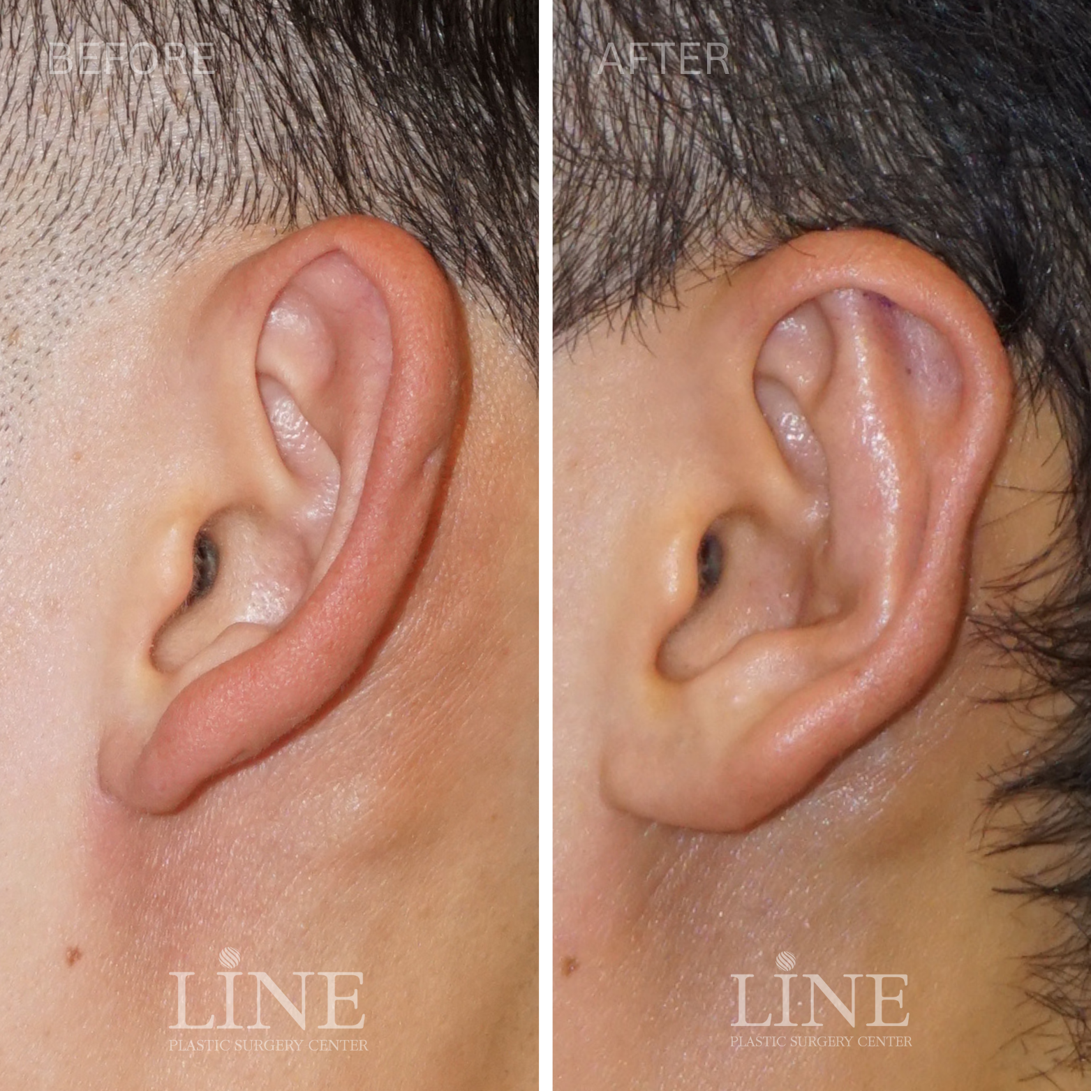 OTOPLASTY (6)