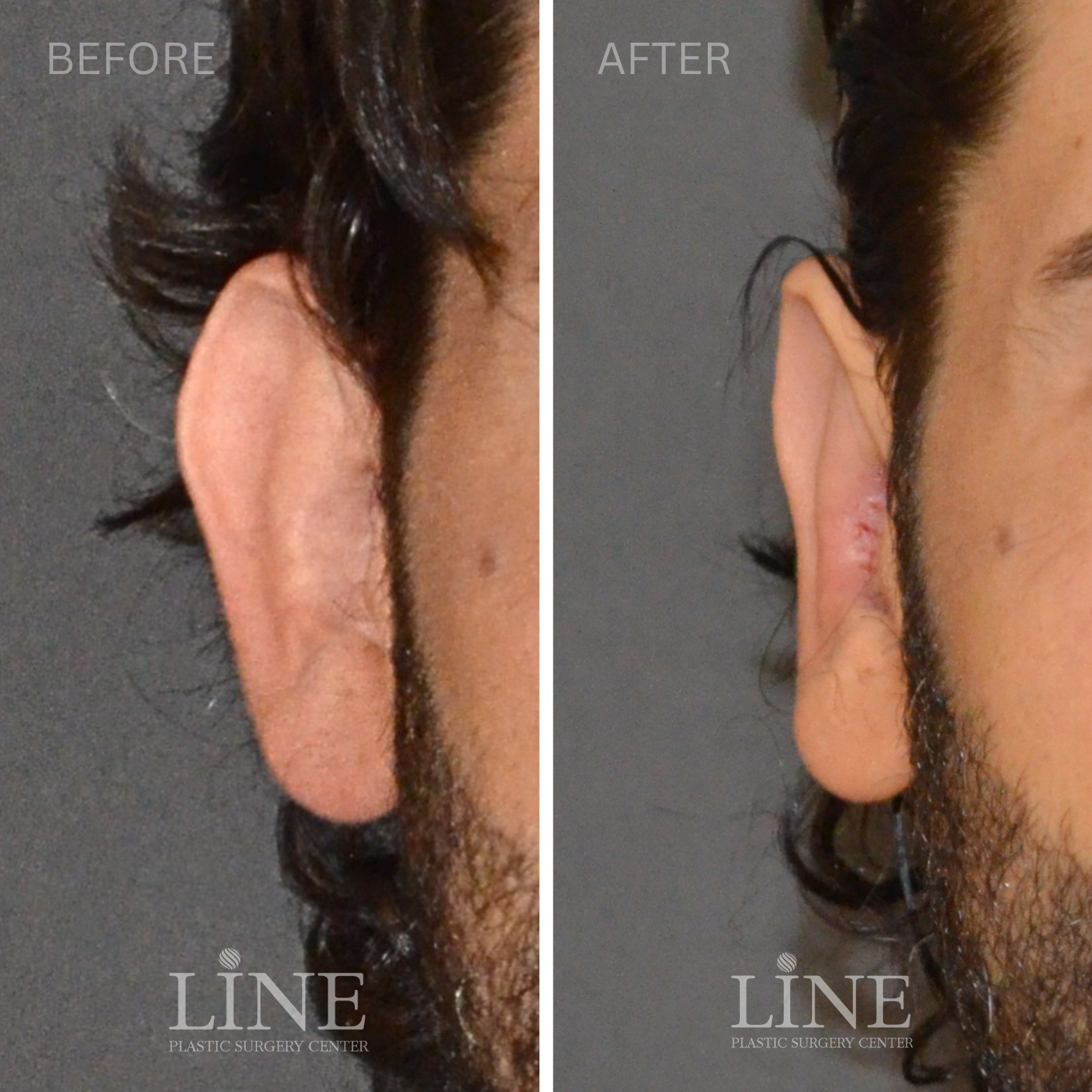 OTOPLASTY (7)