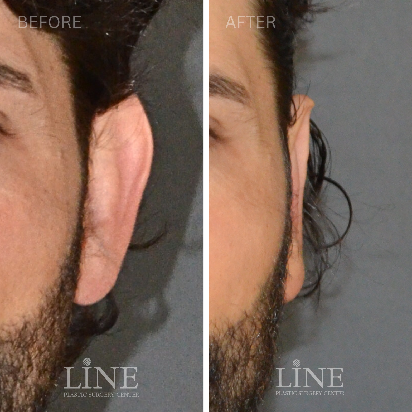 OTOPLASTY (8)