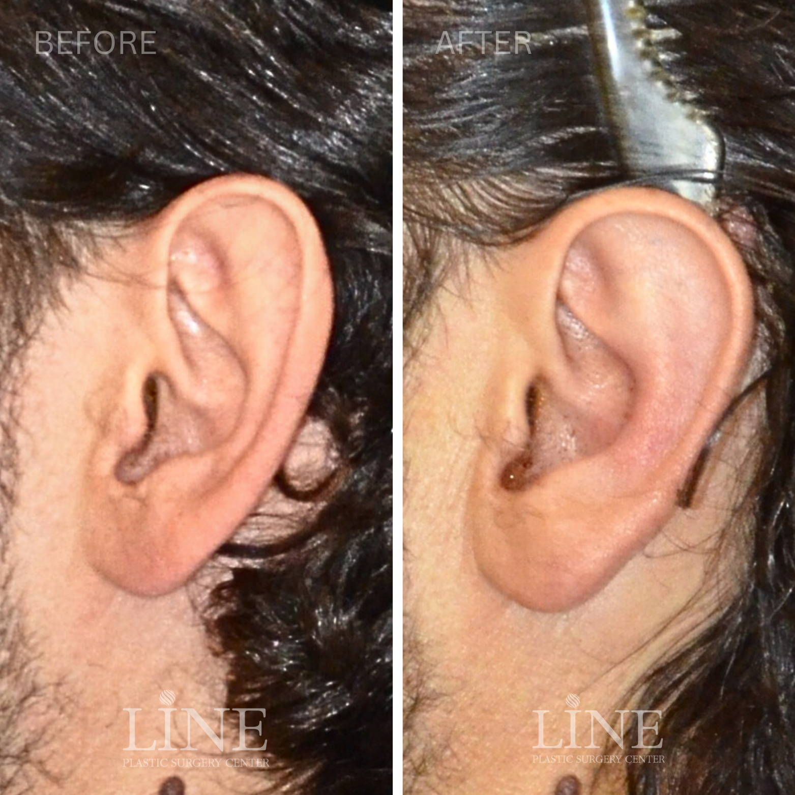 OTOPLASTY (9)
