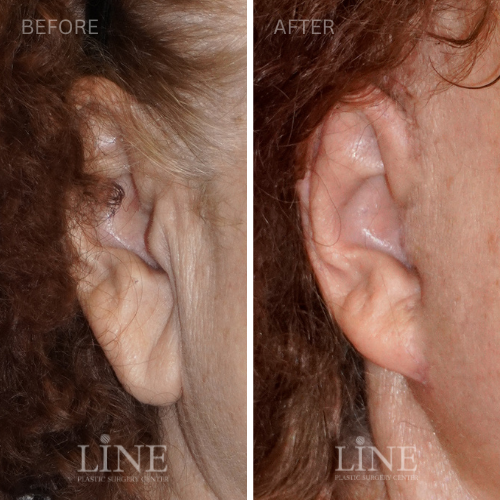 EARLOBE REPAIR (500 × 500 px) (1)