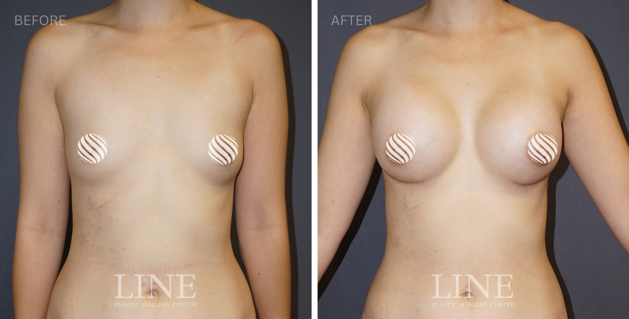 BREAST (1)
