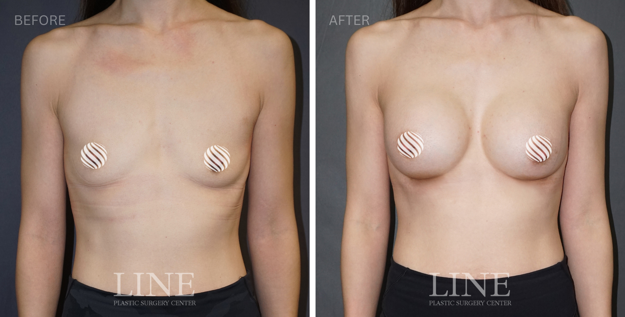 BREAST (10)