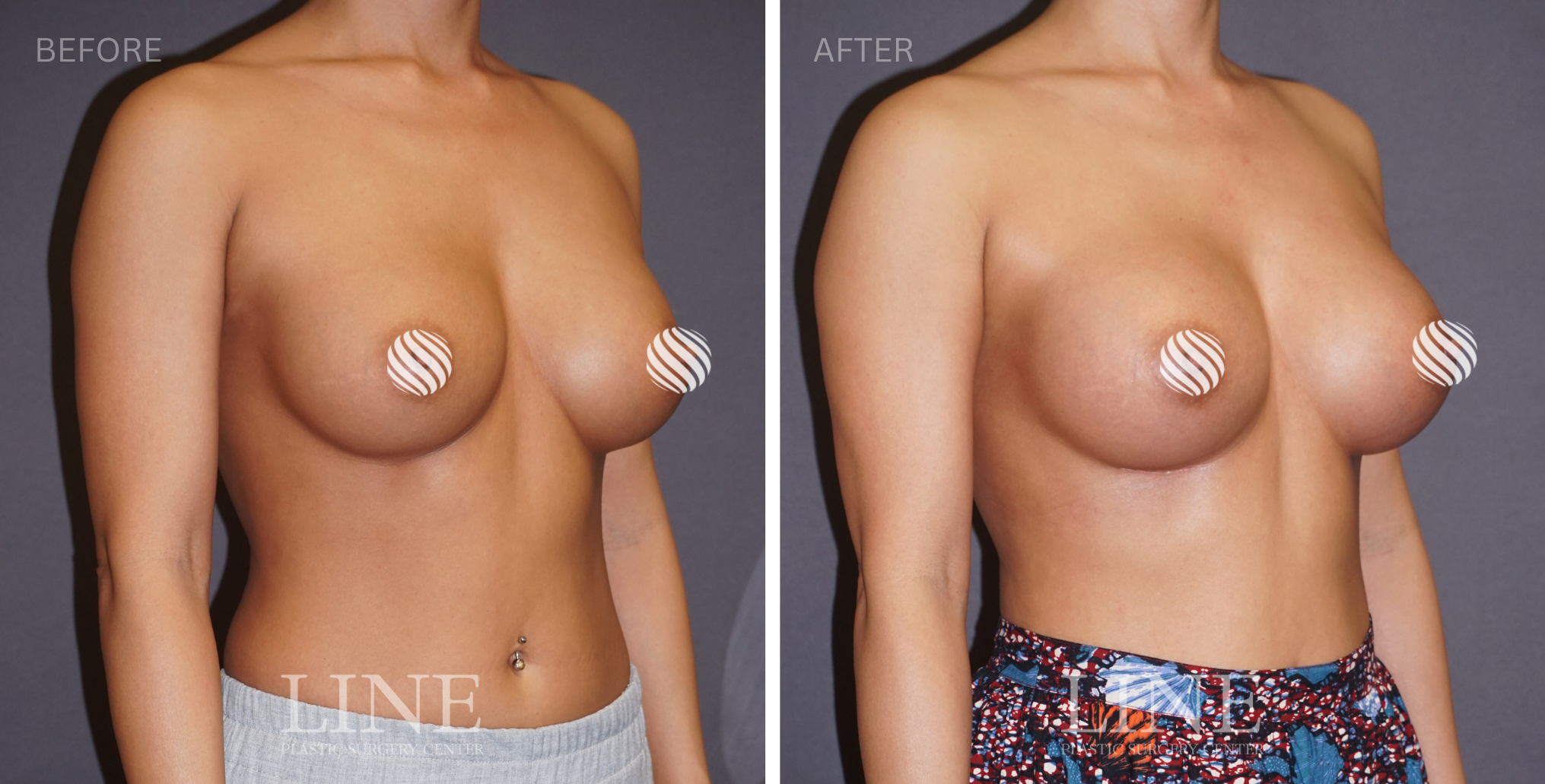 BREAST (11)