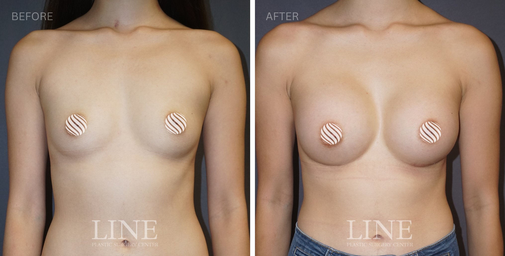 BREAST (12)