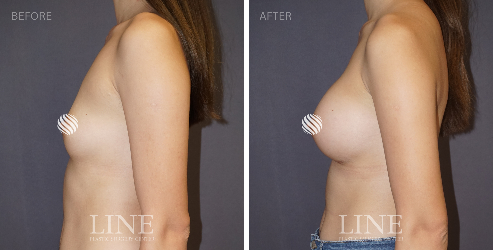 BREAST (13)