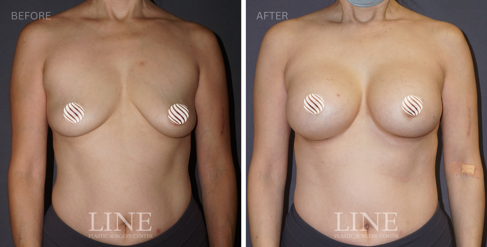 BREAST (14)