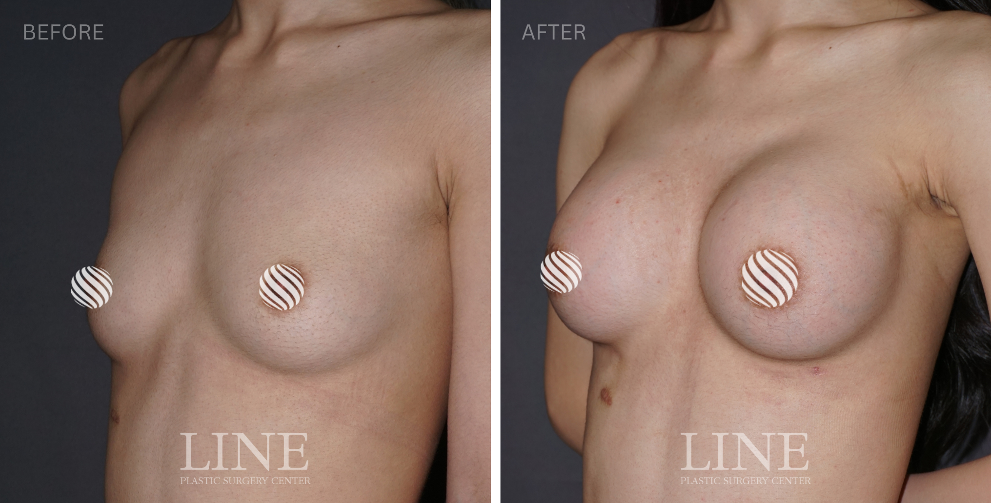 BREAST (15)