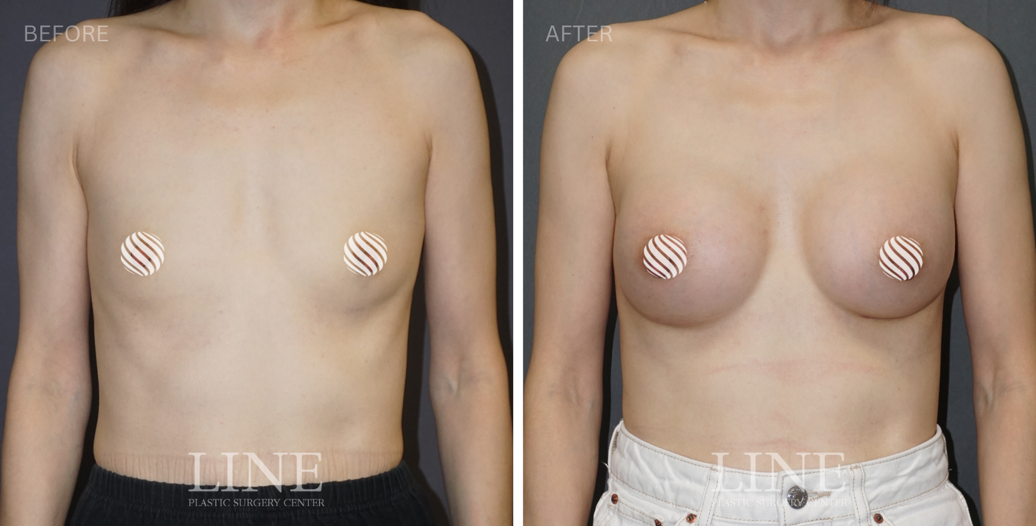 BREAST (19)
