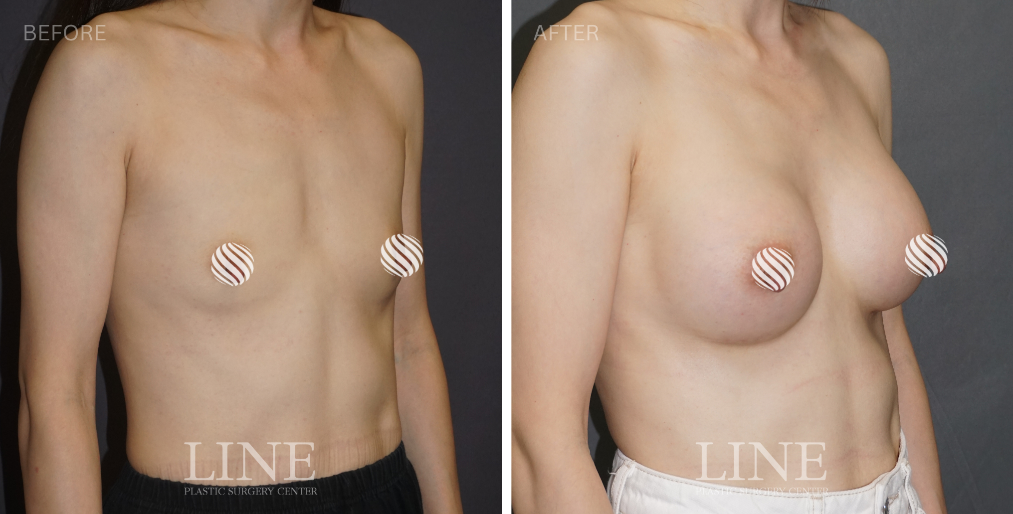 BREAST (20)