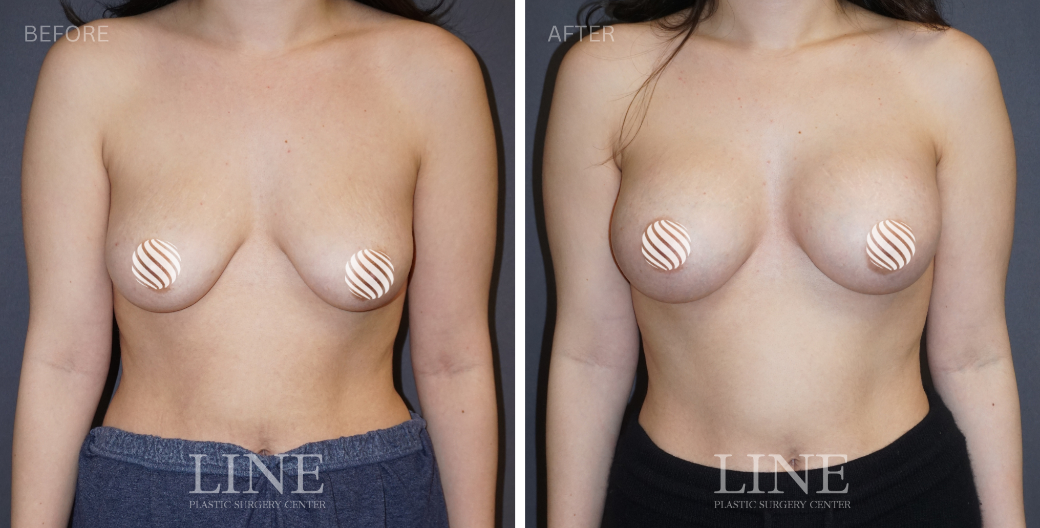 BREAST (3)