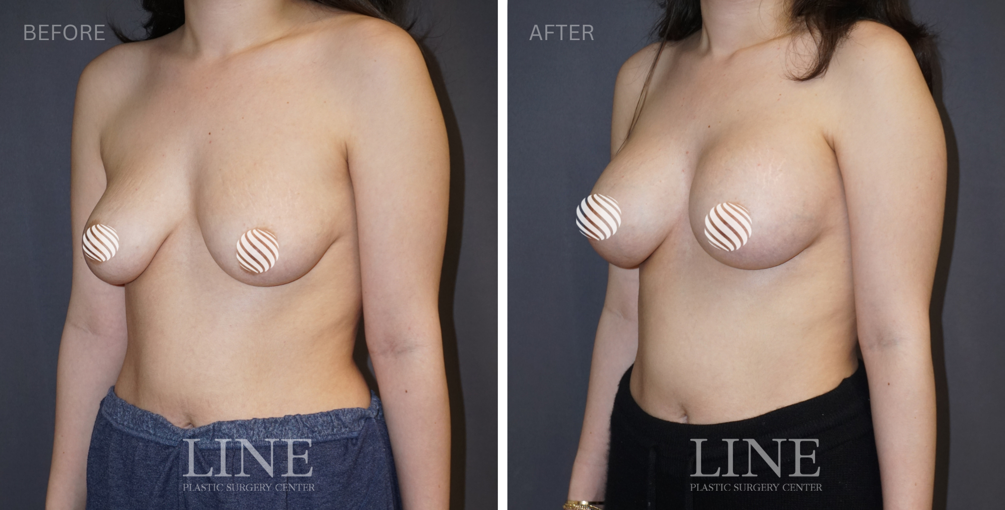 BREAST (4)