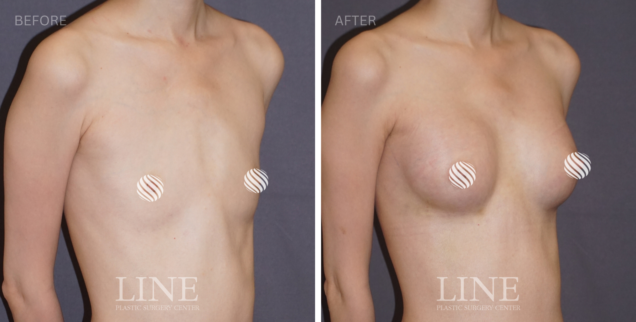 BREAST (5)
