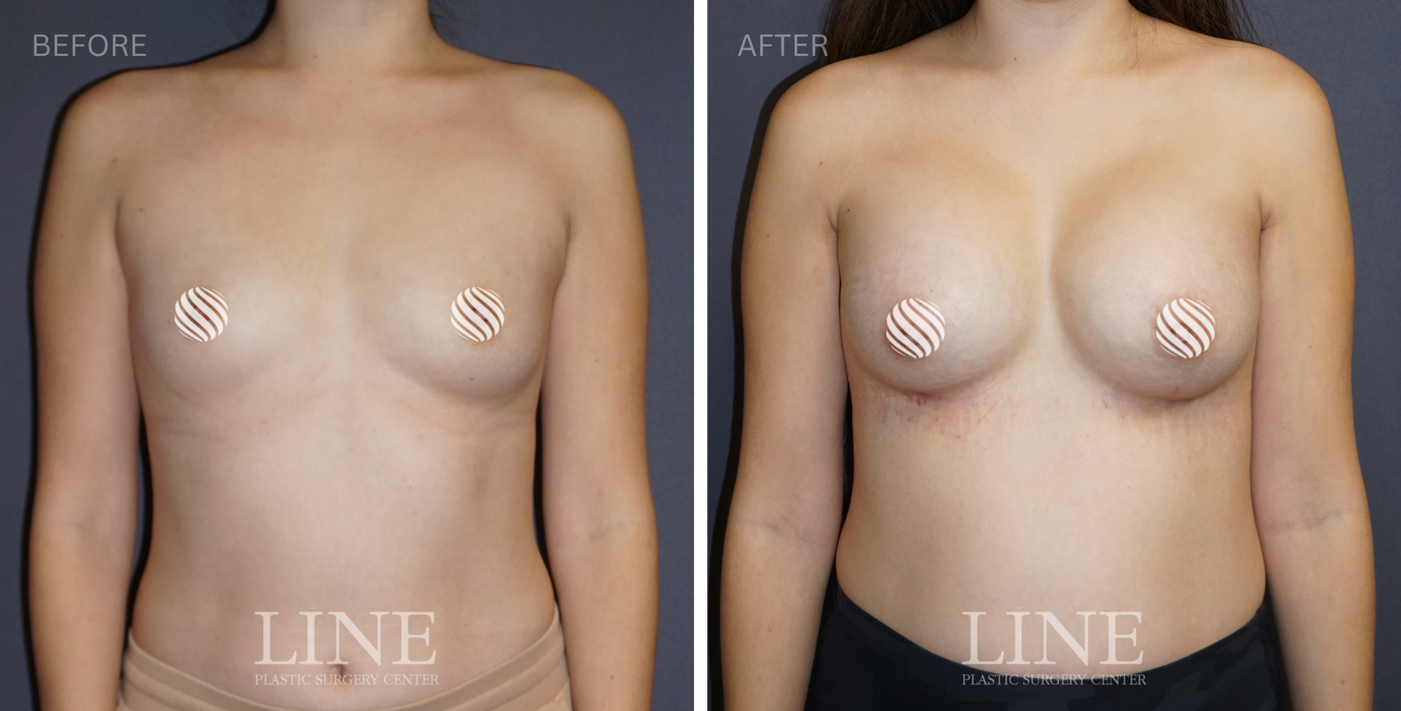 BREAST (6)