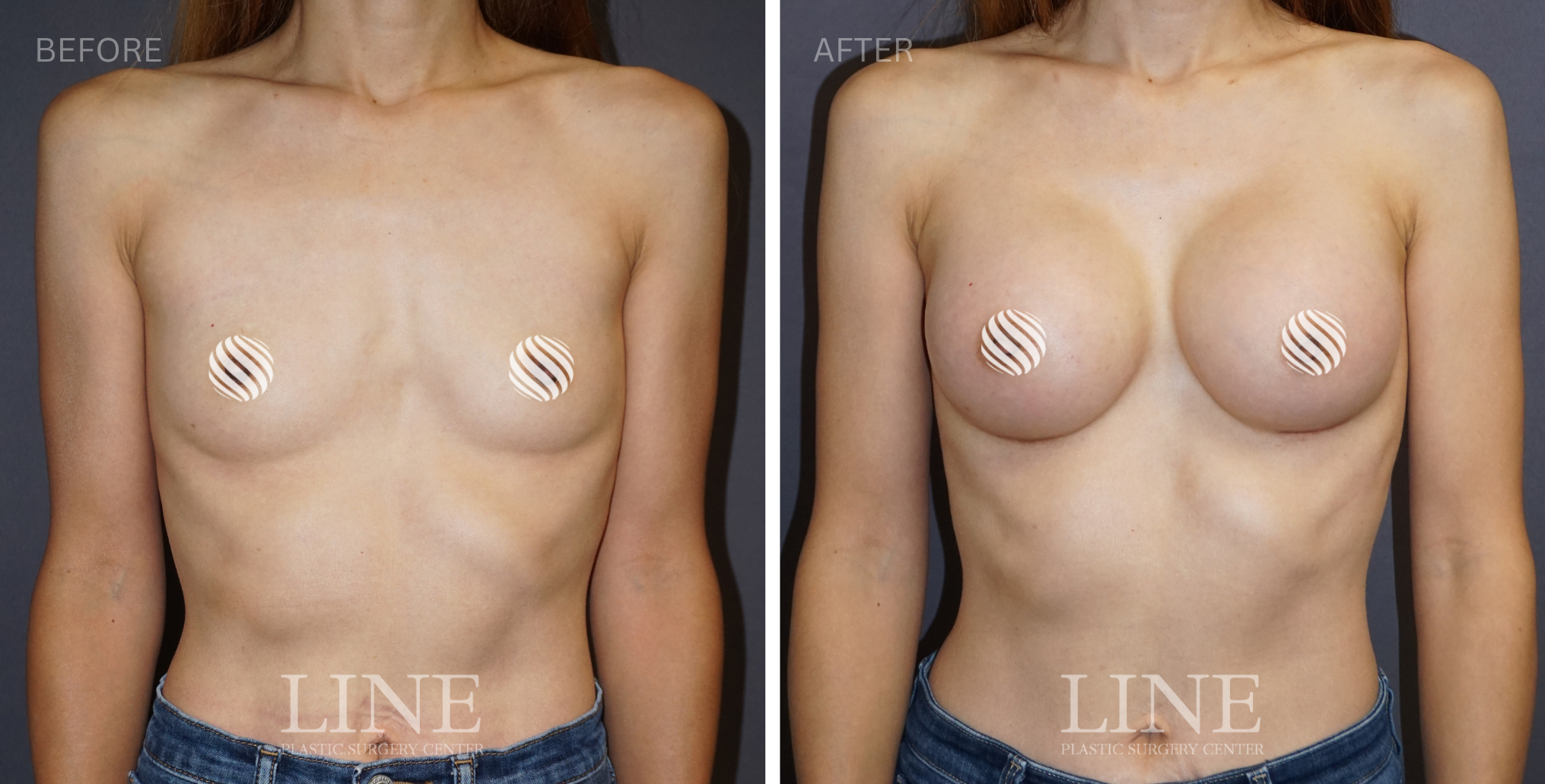 BREAST (8)