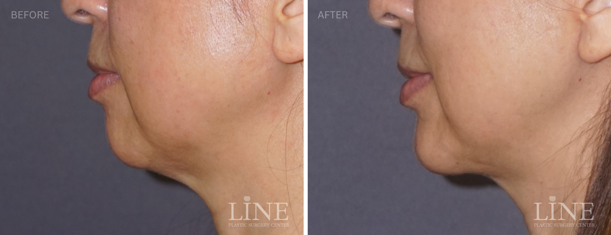 CHIN IMPLANT (13)