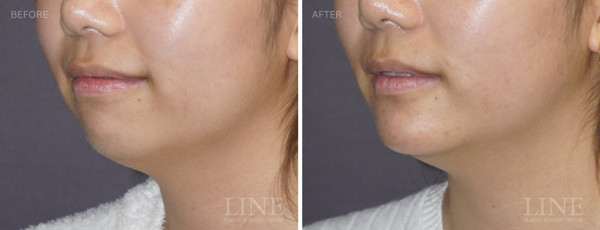 CHIN IMPLANT (14)