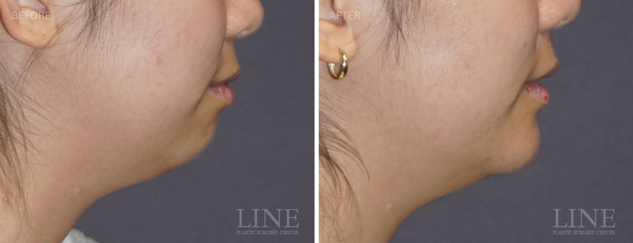 CHIN IMPLANT (15)