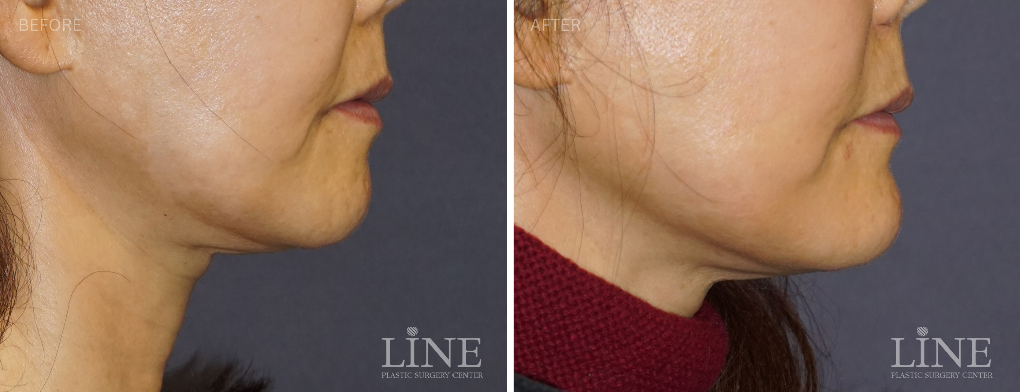 CHIN IMPLANT (5)