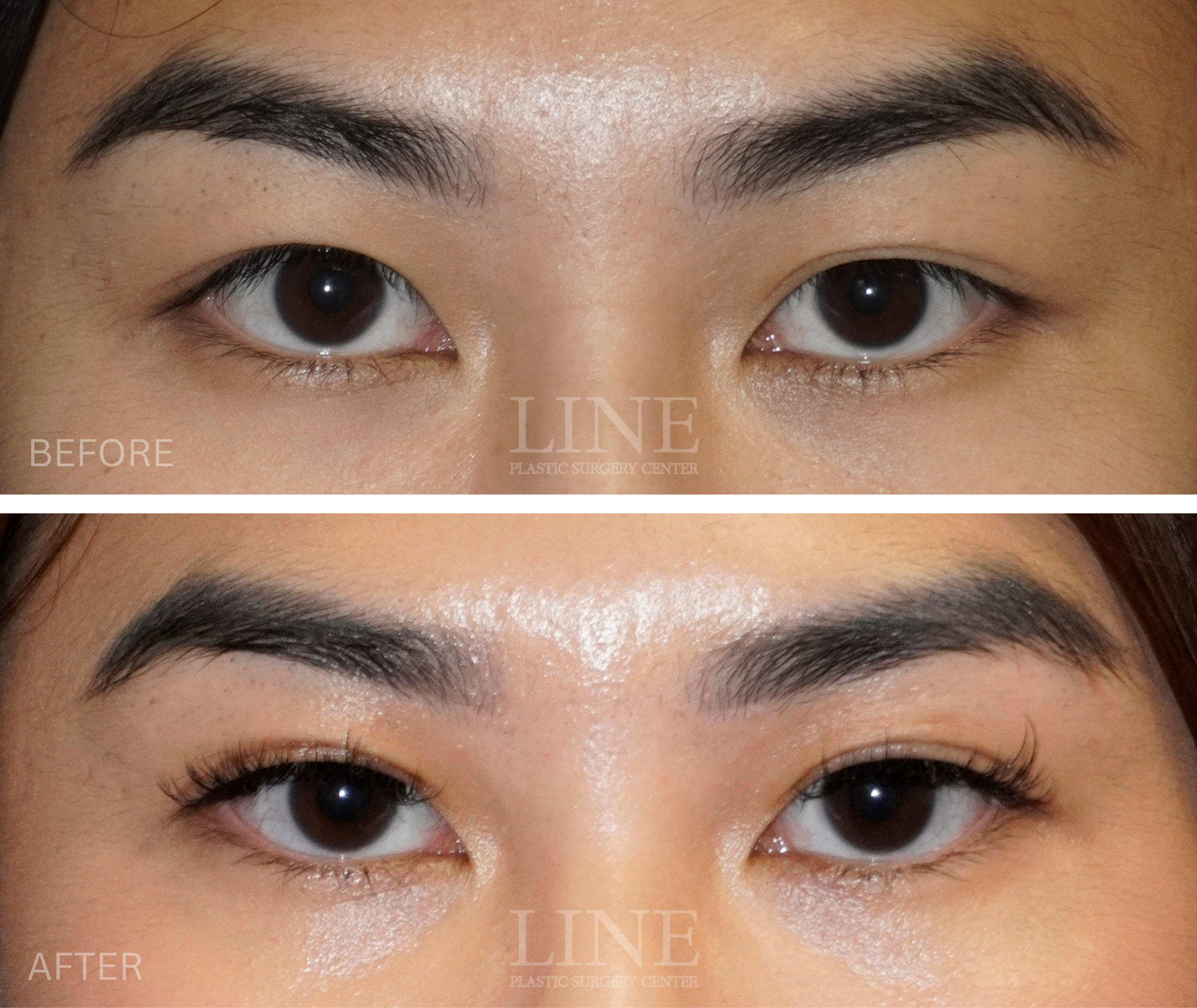 Double Ptosis